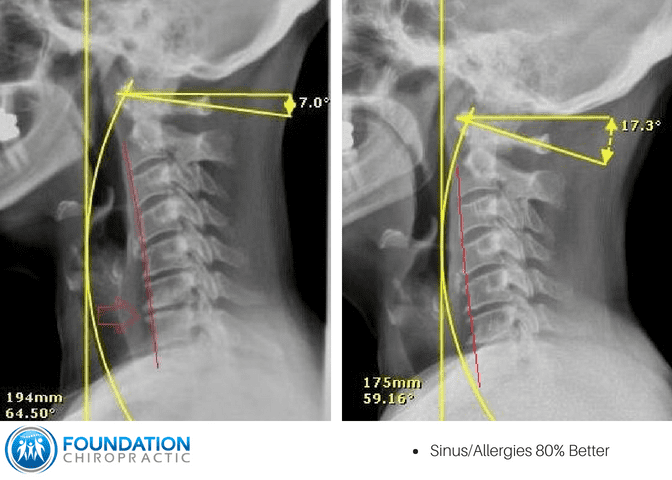 Chiropractic Adjustment Before And After